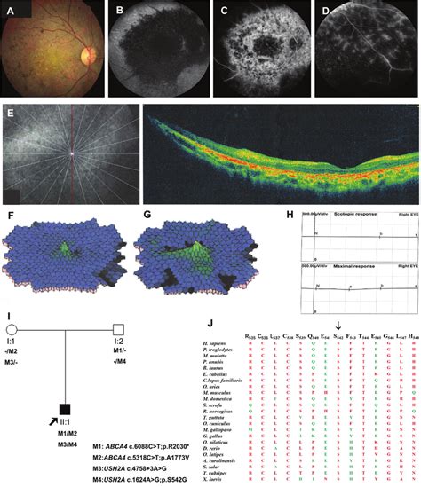 Clinical Characteristics Of The Patient Rp01 Ii 1 A Fundus Examination Download Scientific