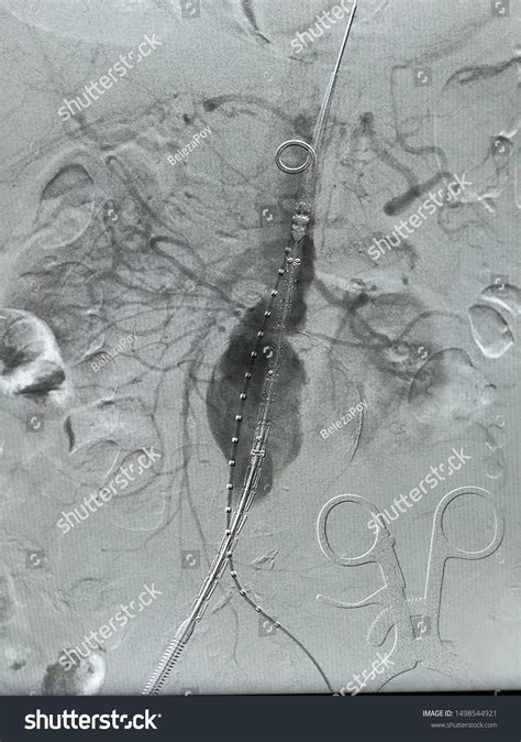 Angiogram Aorta Shown Infrarenal Abdominal Aortic Stock Photo 1498544921 | Shutterstock