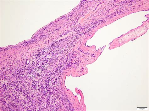 Pathology Outlines Mixed Epithelial And Stromal Tumor