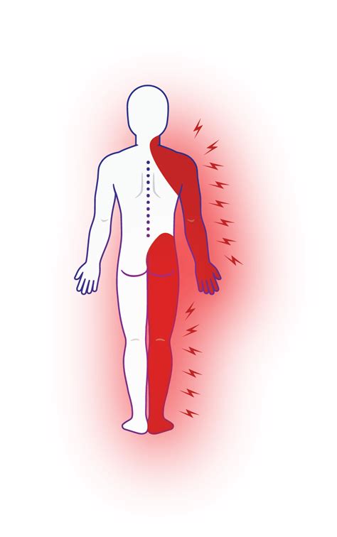 Radicular Pain - MSK Pain