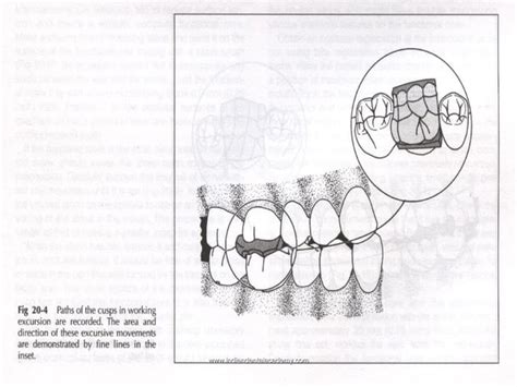 Functionally Generated Path Occlusion Final Cosmetic Dentistry