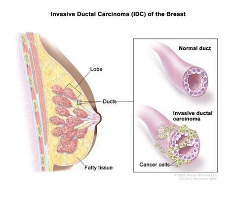 Definition Of Invasive Ductal Carcinoma NCI Dictionary Of Cancer