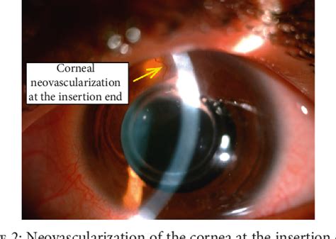 Figure 1 From Clinical Study Femtosecond Laser Implantation Of A 355