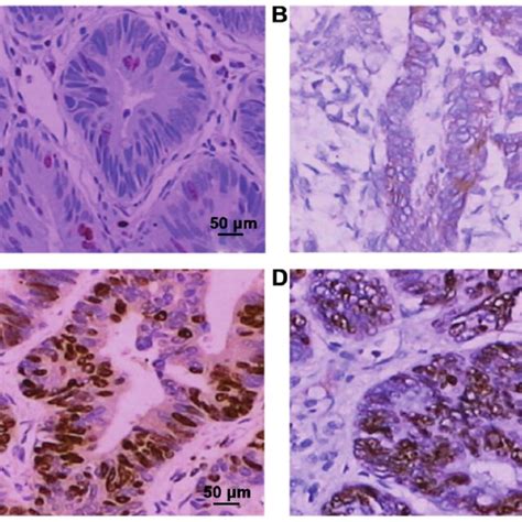 Expression Levels Of JAK 1 And STAT 3 Proteins In Lesion Tissues Of