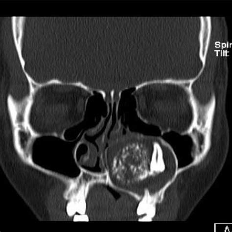 Coronal Ct Scan Of The Patient Showing Well Circumscribed Lytic Lesion