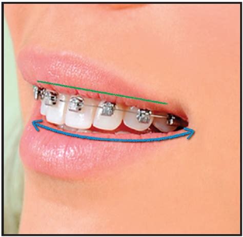 Bracket Positioning For Smile Arc Protection Jco Online Journal Of