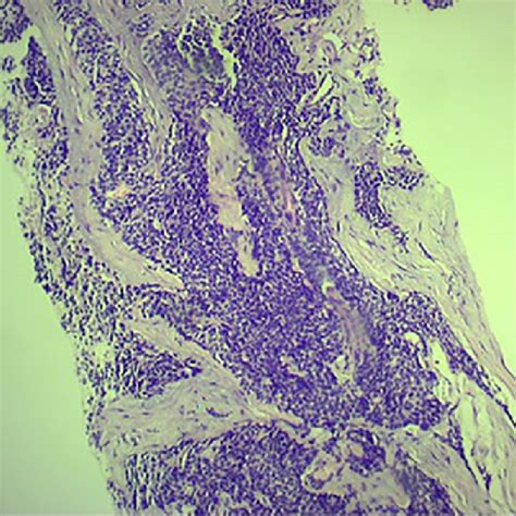 A Small Cell Neuroendocrine Carcinoma High Power View In H And E Stain Download Scientific