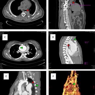 Multidetector Computed Tomography MDCT Scans Of Four Of The Patients