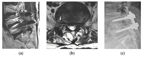 Jcm Free Full Text The Novel Technique Of Uniportal Endoscopic Interlaminar Contralateral