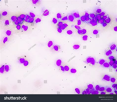 Chronic Myeloid Leukemia Cml Blood Smear Stock Photo 2272732375