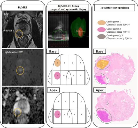 Comparison Of Mri Prostate Biopsy Targeted And Systematic And