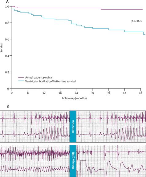 Arrhythmogenic Right Ventricular Cardiomyopathy The Lancet