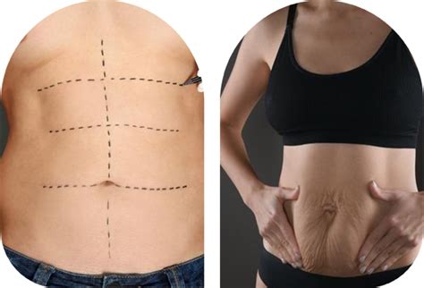 Abdominoplasty Tummy Tuck Mr Ammar Allouni Consultant Plastic Surgeon