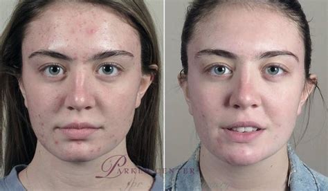 Advanced Acne Treatment Before And After Photo Gallery Paramus New Jersey Parker Center For