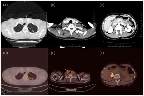 Genomic Profiling Of Synchronous Triple Primary Tumors Of The Lung