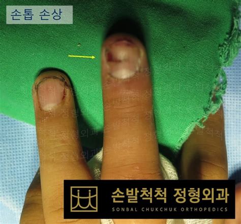 손발척척 정형외과 수술센터 수술센터 수술센터 개방성 골절의 수술과 손톱 손상으로 인한 인조손톱의 삽입