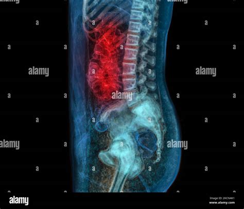 CT Colonography Or CT Scan Of Colon 3D Rendering Image For Screening