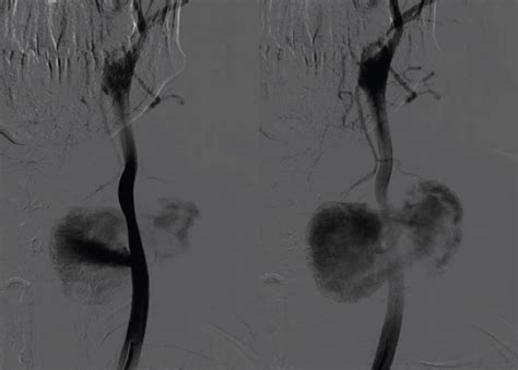 Spontaneous Aneurysm of External Carotid Artery: Management and ...