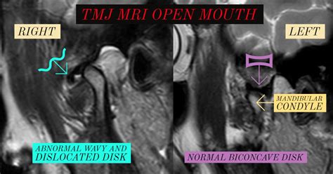 Angel Gómez Cintrón Md Mph On Twitter Tmj Disk Dislocation The Mri