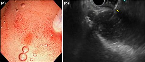 Gel Immersionassisted Endoscopic Ultrasoundguided Gallbladder