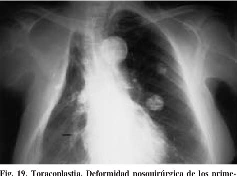 Manifestaciones Radiol Gicas De La Tuberculosis Pulmonar Semantic Scholar