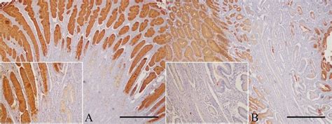 Gastric Polyps Immunohistochemistry For Tff Counterstained With