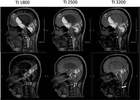 Chiari Malformation In A 43 Year Old Woman Pre Top Row And Post