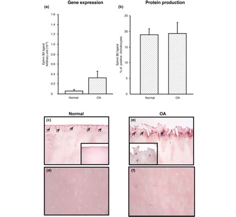 Ephrin B2 A Gene Expression Level In Human Normal N 5 And