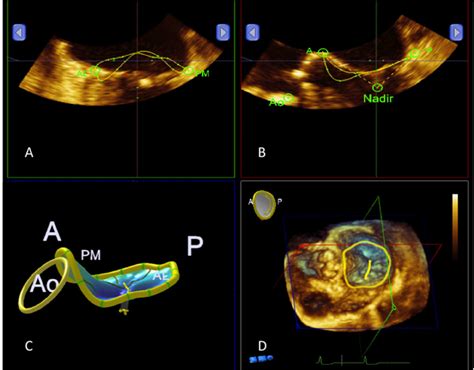 Three Dimensional D Mitral Valve Mv Reconstruction A Al