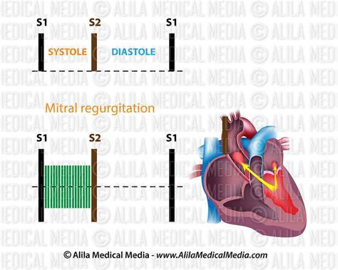 Alila Medical Media | Heart murmurs mitral regurgitation | Medical ...