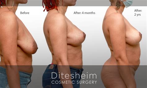 Lipo Charlotte NC Ditesheim Cosmetic Surgery