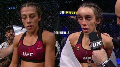 Female Ufc Fighter Joanna Jedrzejczyks Face Left Disfigured After