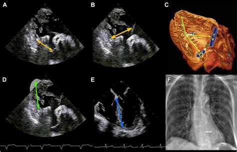 Exploratory Use Of Intraprocedural Transesophageal Echocardiography To