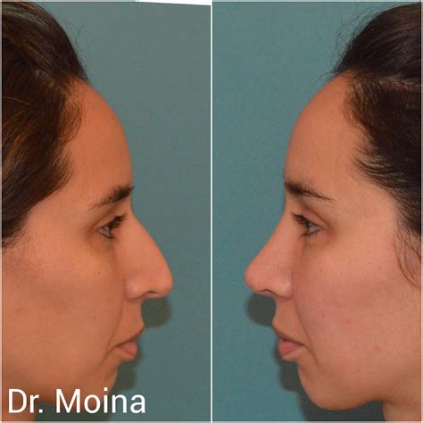 Rinoplastia Antes Y Despu S Rinoplastia Expertos Dr Moina