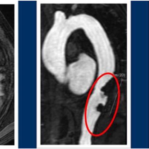 Magnetic Resonance Angiographic Images Showing A Voluminous Filling Download Scientific Diagram