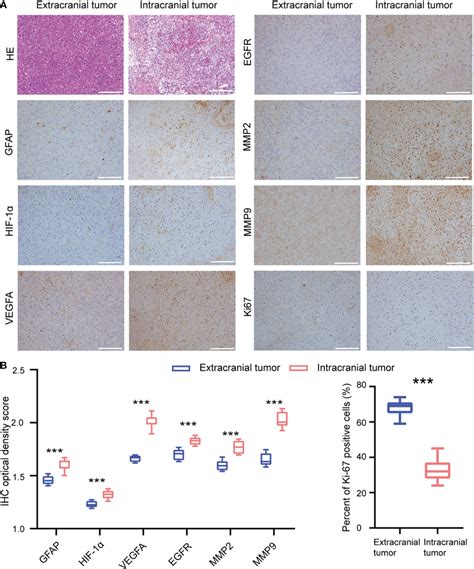 Immunohistochemistry Analysis Of The Extracranial Tumor And