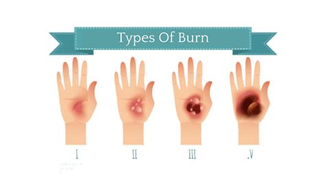 Different Types Of Burns Das Oncocare