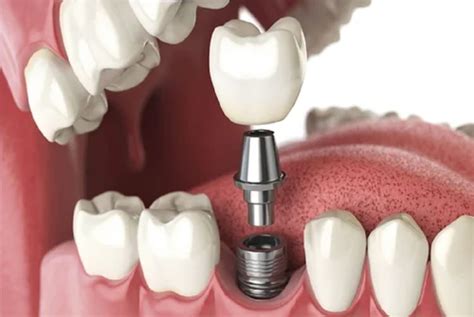 The Complete Guide To Dental Implants