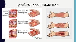 Primeros Auxilios en quemaduras