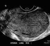 Endometrial thickness | Radiology Reference Article | Radiopaedia.org