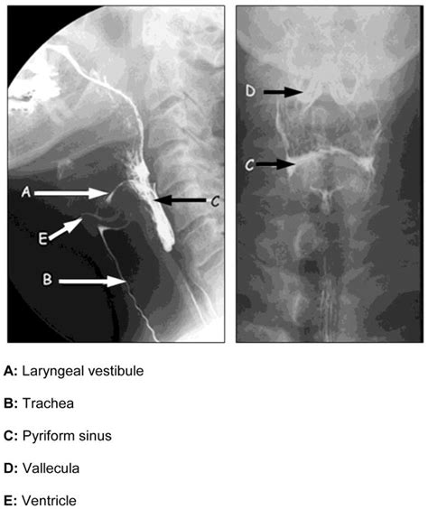 Valleculae And Pyriform Sinuses