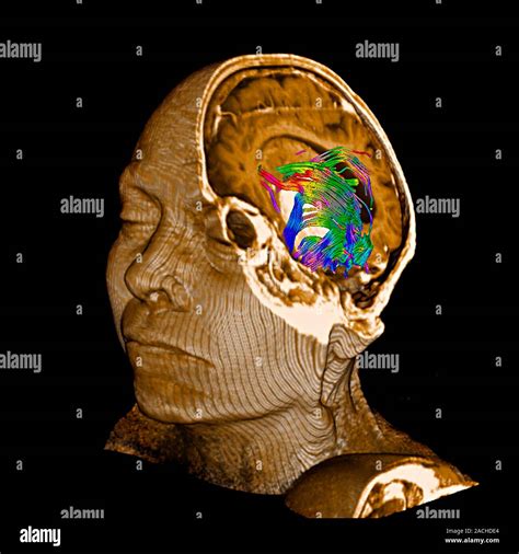 Tumore Del Cervello Colorato D Imaging Del Tensore Di Diffusione Dti