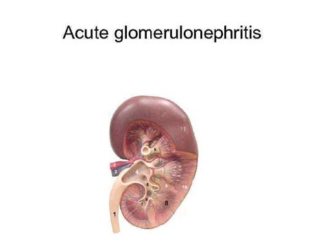 Acute Glomerulonephritis Glomerulonephritis Heterogenic Group Of