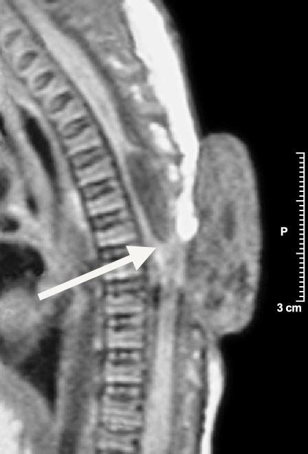 Thoracic Meningocele Semantic Scholar