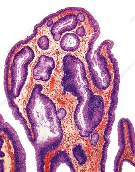 Adenoma Of Colon Light Micrograph Stock Image C Science