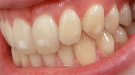 Manchas Brancas nos Dentes O Que São Quais as Causas e Como Tratar