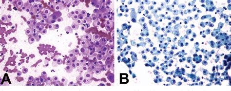 Figure 3 From Diagnosis Of Metastatic Renal Cell Carcinoma On Fine