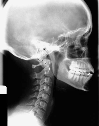 Analyzing The Lateral Cervical X Ray Musculoskeletal Key