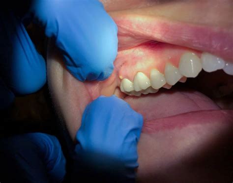 Absceso Dental Tratamiento Y Causas Clinica Dental Palomero