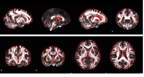 Correlation Between White Matter Damage And Gray Matter Lesions In Multiple Sclerosis Patients